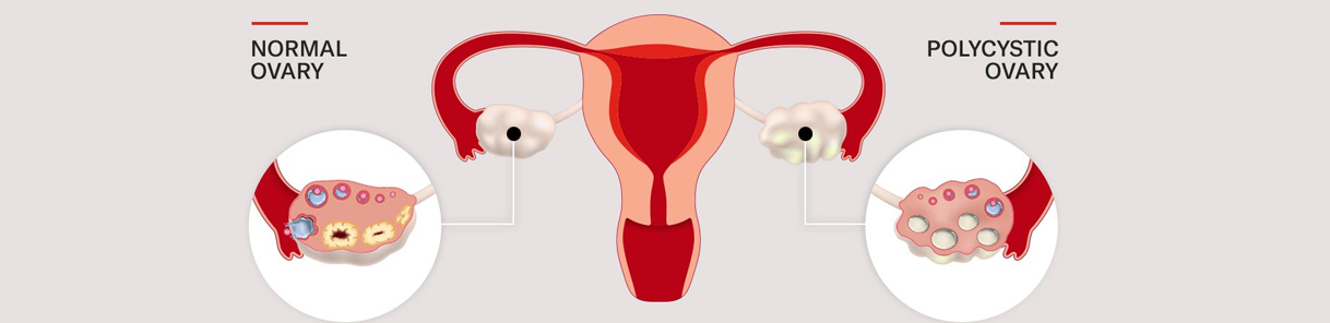 PCOS & Other HORMONAL PANEL