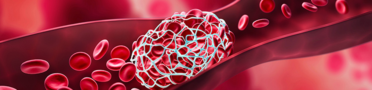 DVT/ Hypercoagulable